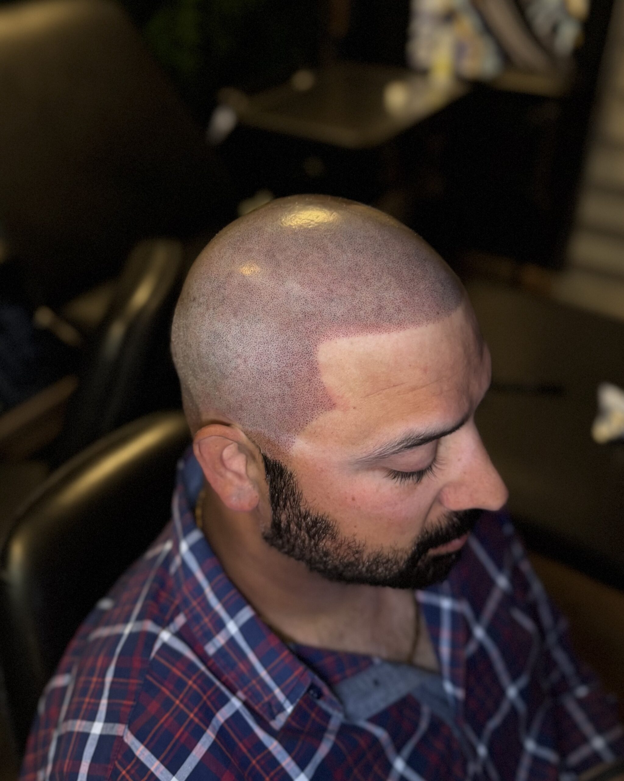 Scalp Micro Pigmentation